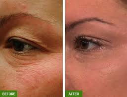madonna eye lift agape medical spa