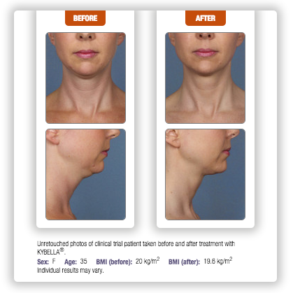 kybella agape medical spa