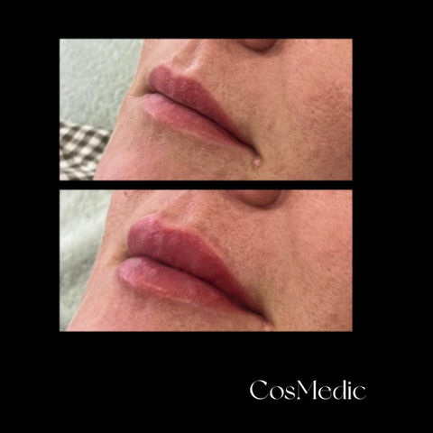 Lips