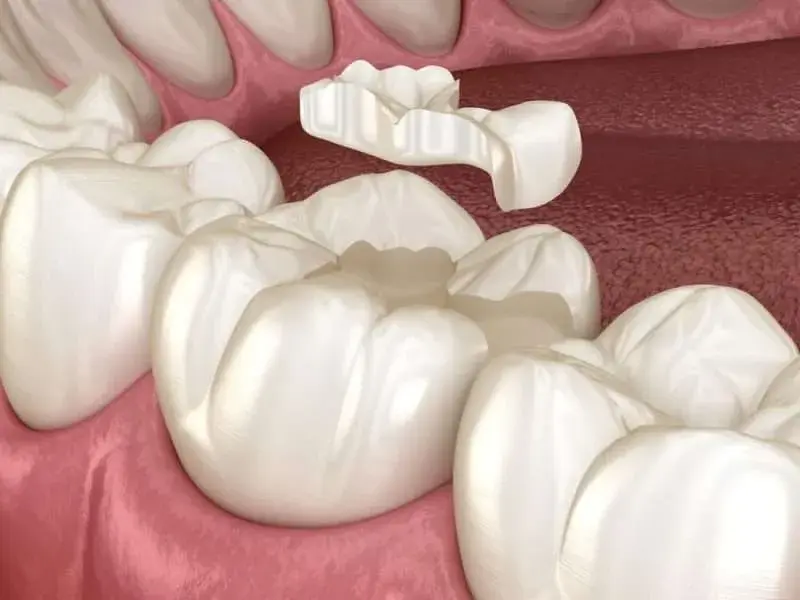inlay and onlay at Flawless Dental Care