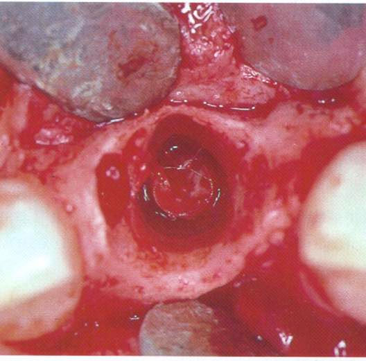 Implants and Immediacy: an old discussion, a new concept!