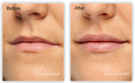 Restylane lip filler before and after