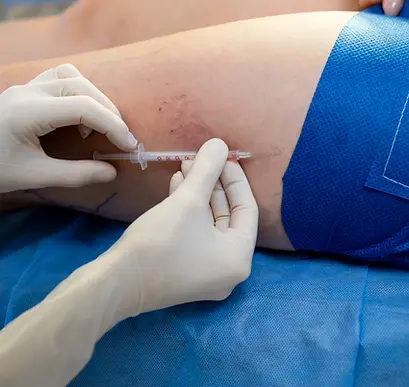 Αντιμετώπιση ευρυαγγειών και μικρών κιρσών με τη μέθοδο της σκληροθεραπείας