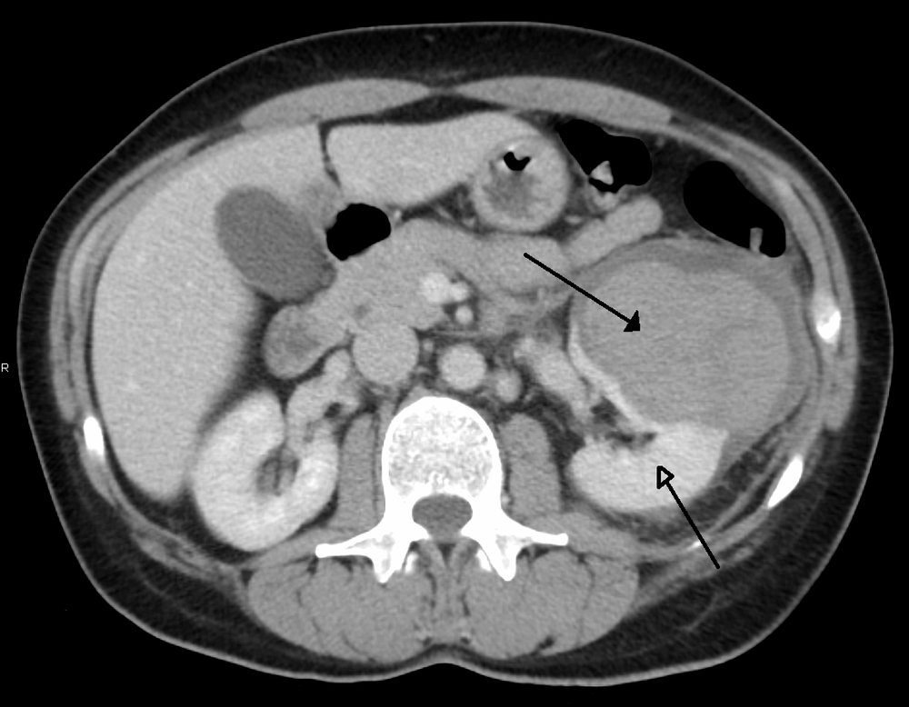 Retroperitoneal Space Images And Photos Finder