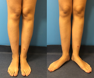 Rotational Deformity | Miserable Malalignment | Dr. Fragomen