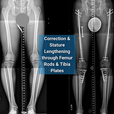 Limb Lengthening and bow legs Surgery