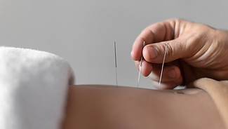 acupuncture treatment