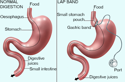 Gastric Band Hypnosis