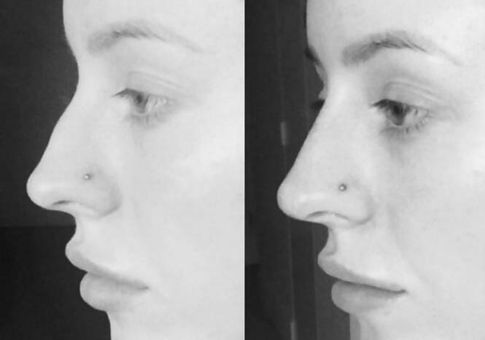 NOSE FILLER