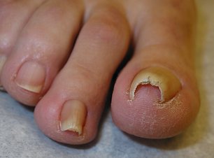 nail deformation.png