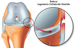 LEGAMENTO COLLATERALE MEDIALE E LATERALE