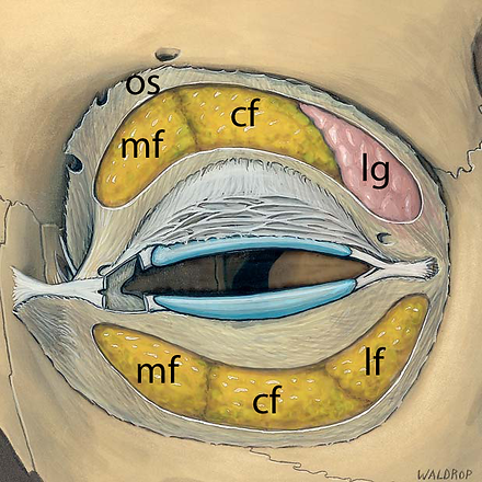 Preaponeurotic fat pockets in the upper and lower eyelids
