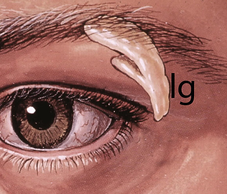Lacrimal gland in the orbit