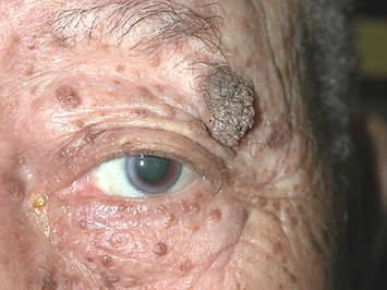 Mulitple seborrheic keratoses on the eyelids and forehead