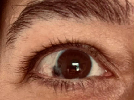 Nahaufnahme eines offenen braunen Auges mit dunkler Augenbraue; im Auge spiegelt sich ein heller Raum. Links neben der Iris ist ein dunkler Fleck zu erkennen.