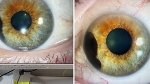 Nahaufnahme von zweimal dem gleichn Auge mit braun-grünem Muster, links auf Bildschirm, rechts real. Detalliert und scharf mit klaren Farben. Auf beiden Augen ist das Aderhautmelanom klar zu erkennen als schwarzer Fleck. Links aber kleiner als rechts.