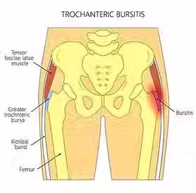 Anatomibild-pa-snapping-hip-och-trokanterit-och-trokanterit-bursit.avif