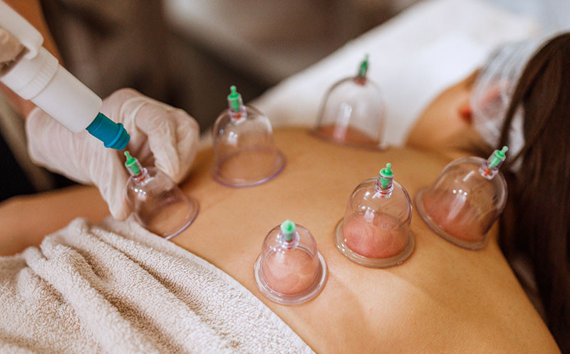 Cupping