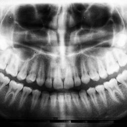 Digital X-rays | Thomas Crossroads Dental Center