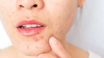 Adult Acne? Causes, Treatments & Prevention