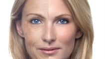 All You Need To Know About Microneedling