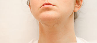 Achieve Smooth, Confident Skin: Effective Solutions for PCOS-Related Facial Hair