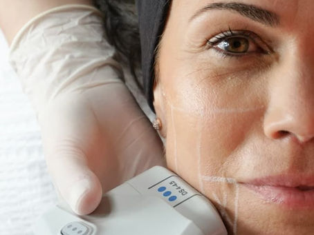 HIFU: De Revolutionaire Anti-Aging Behandeling Zonder Chirurgie