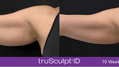 TruSculpt iD arms treatment
