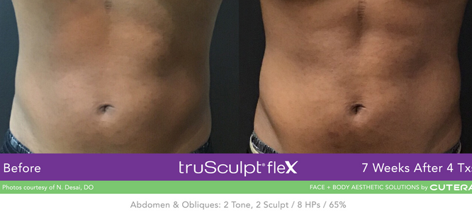 The Emsculpt alternative
