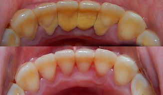 ANTES-Y-DESPUÉS-DE-UNA-LIMPIEZA-DENTAL.j