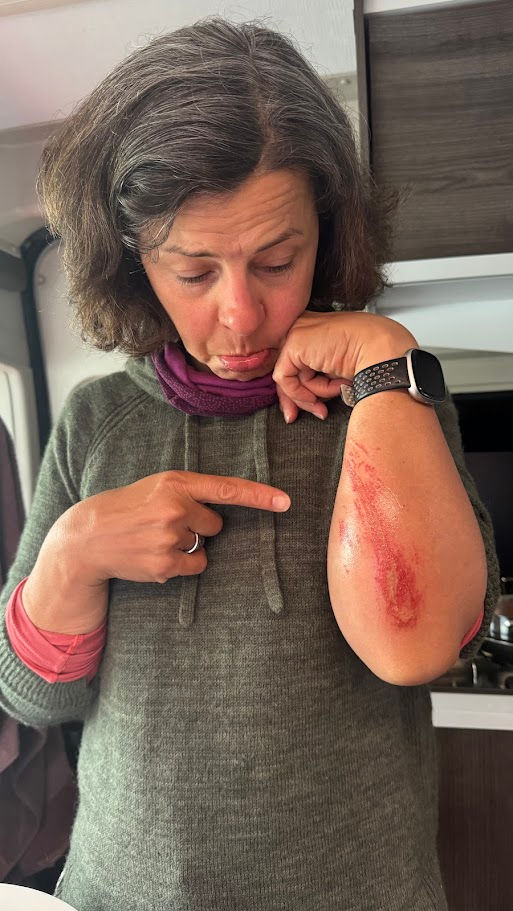 My road rash...taken a few days later