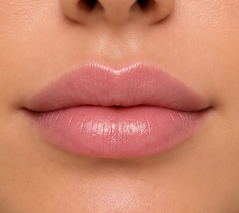 Illustrative example of subtle 1.0 mL lip filler enhancement
