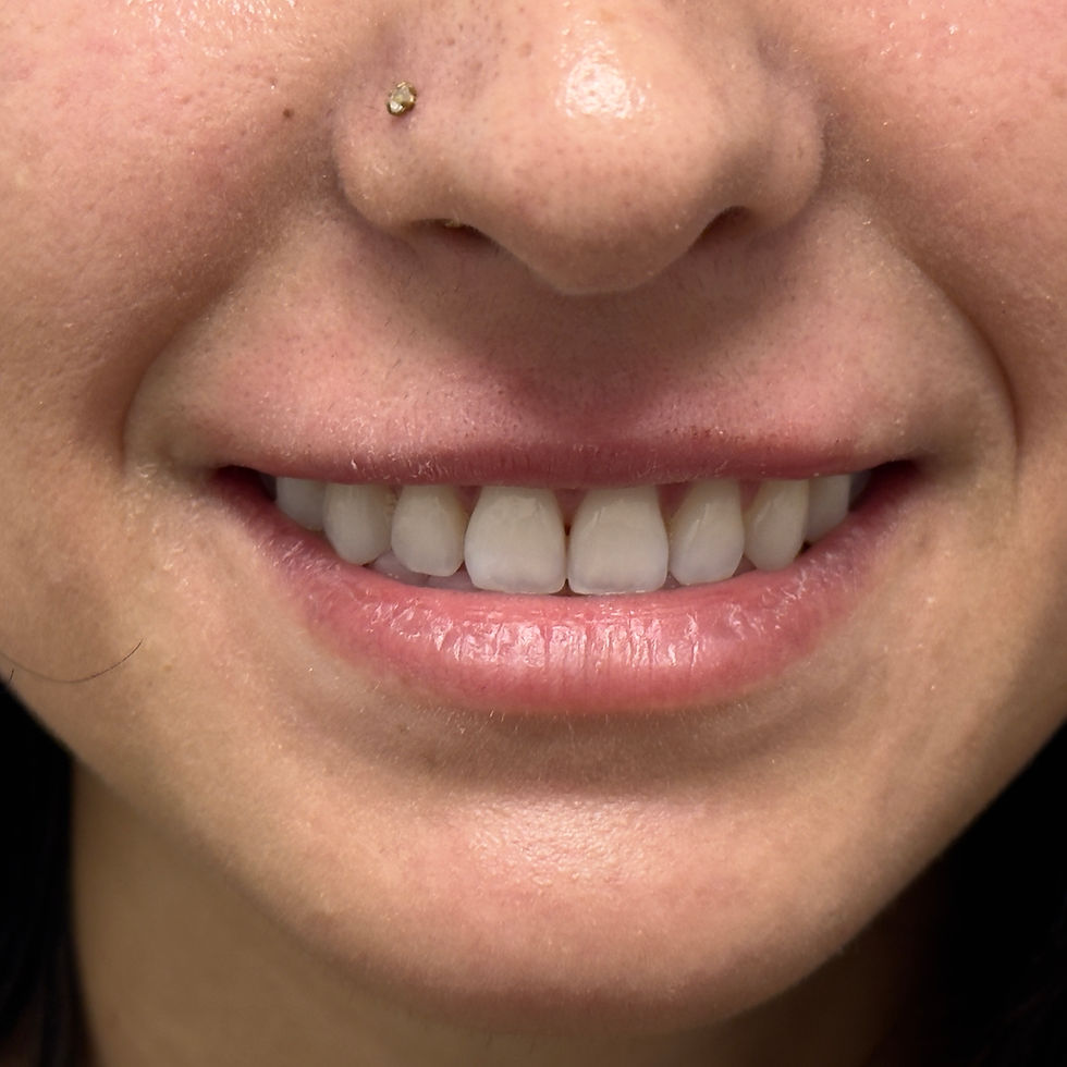 Natural upper lip before Dysport lip flip treatment