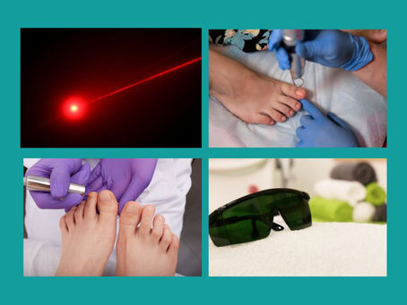 Tecnologia laser em Podologia: precisão e resultados