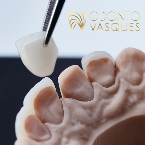 Facetas e Lentes de Contato Dentárias