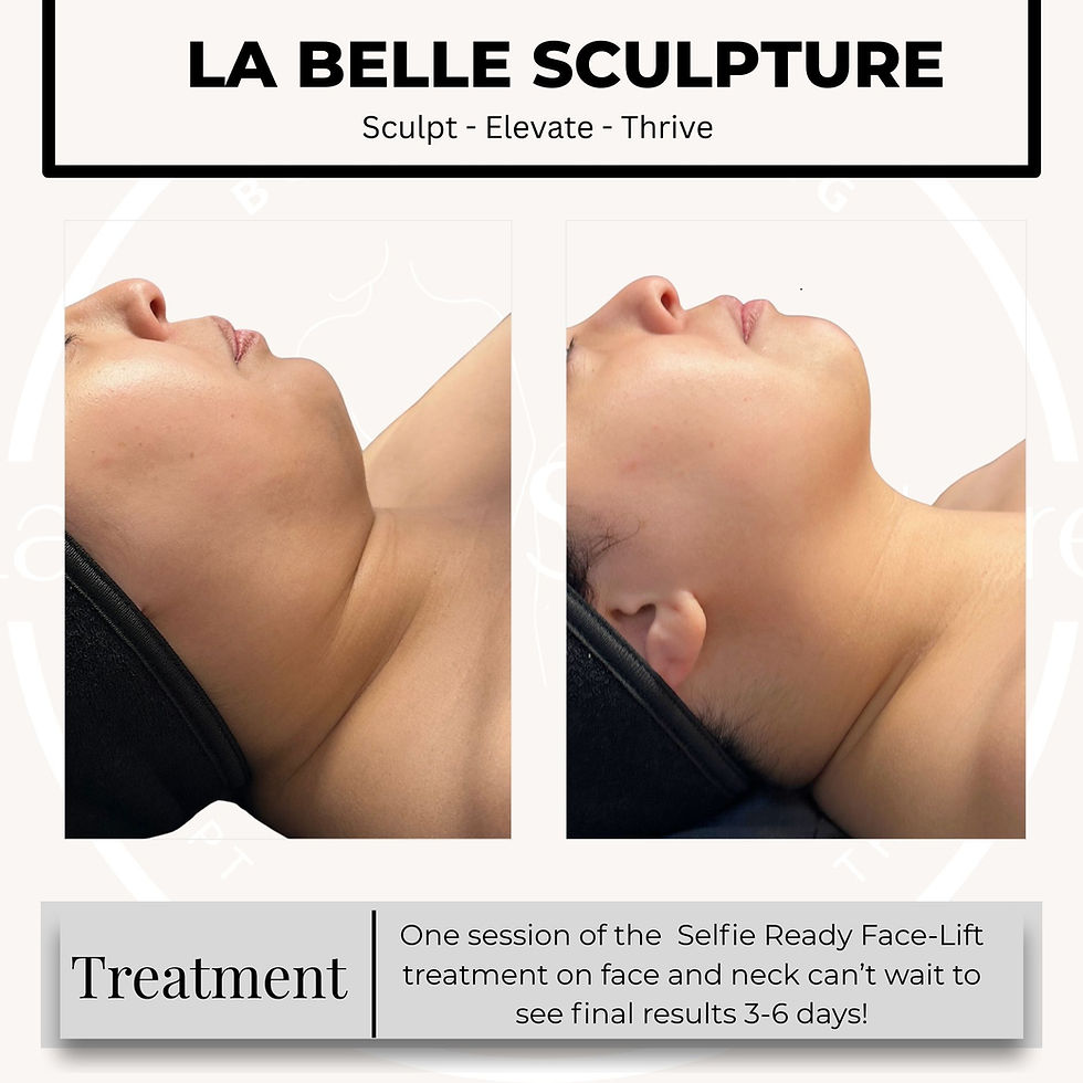Female side profile showing results of Selfie Ready Facelift non-surgical double chin removal