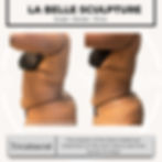 Before and after Mommy Makeover treatment showing fat reduction and contouring results – La Belle Sculpture