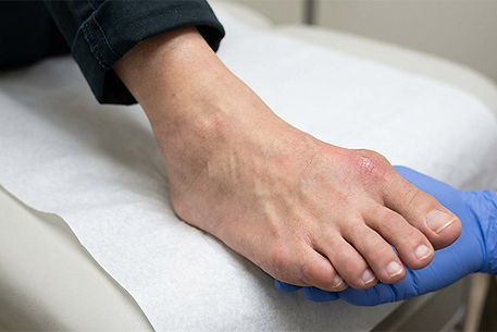 Bunion treatment including minimally invasive surgery in San Antonio TX by Dr. Andrew Gunter DPM