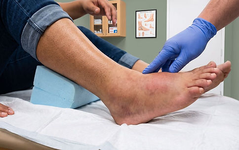 Metatarsal fracture treatment in San Antonio TX by Dr. Andrew Gunter DPM podiatrist