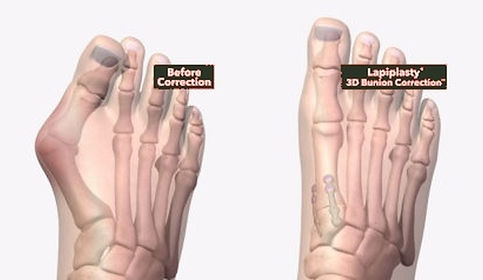 Lapiplasty 3D bunion correction in San Antonio TX by Dr. Andrew Gunter DPM — credentialed Lapiplasty provider