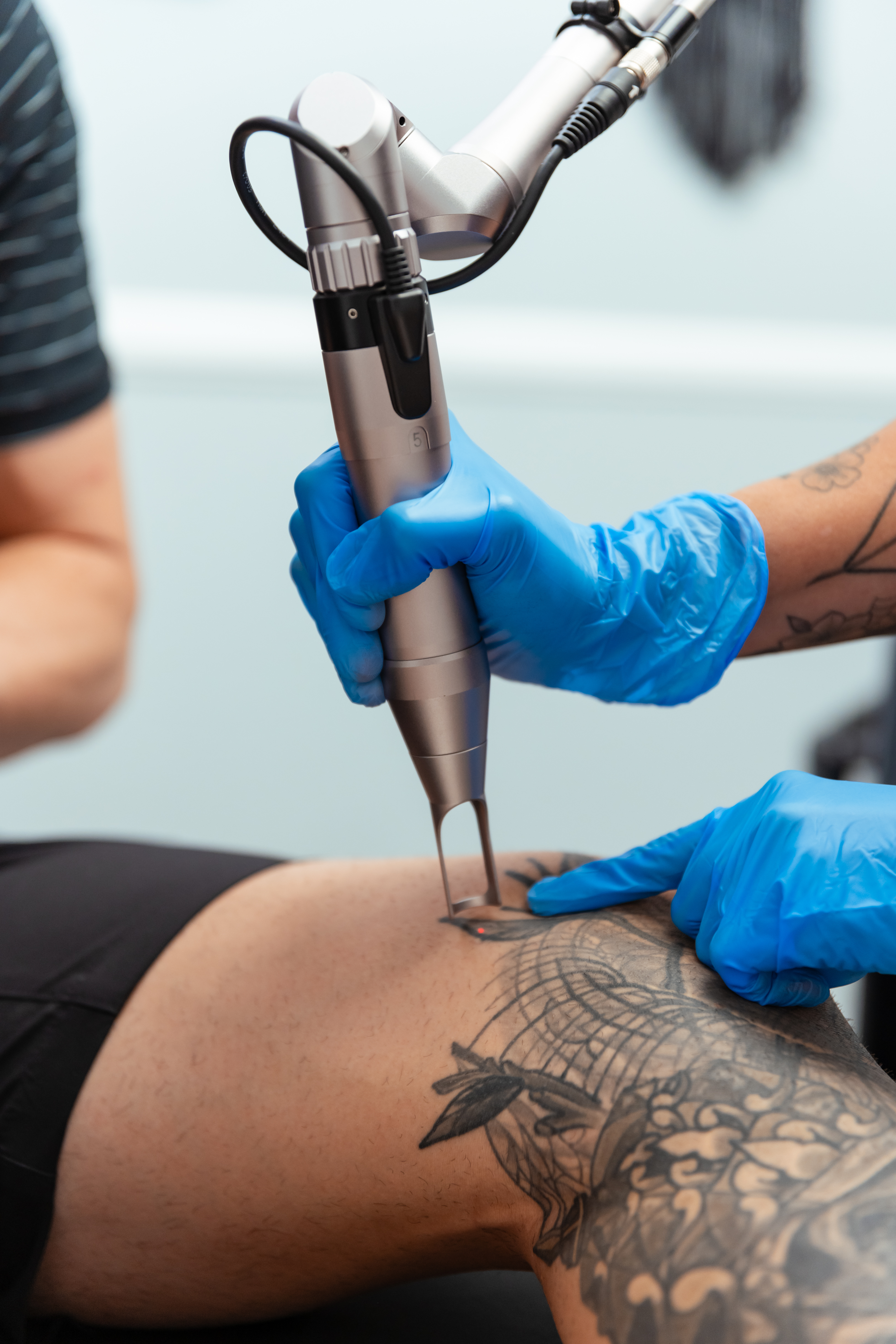Close-up of Suddenly Sculpted and Sexy tattoo removal technician using removal instrument on patient, Arizona.
