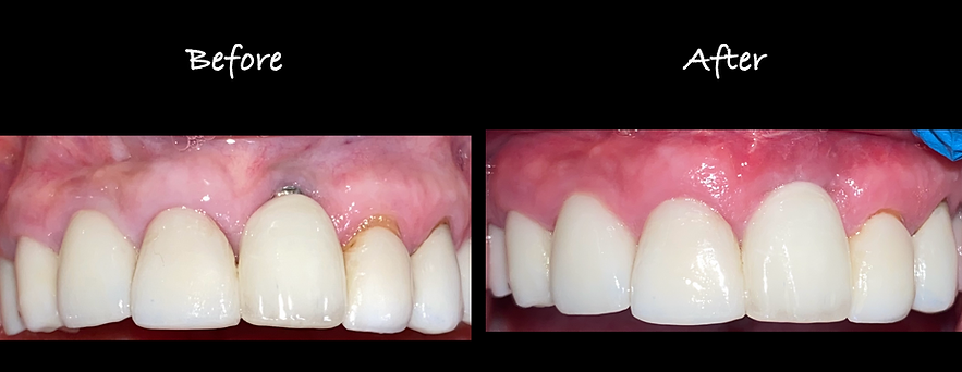 Gum graft for implant-case 1
