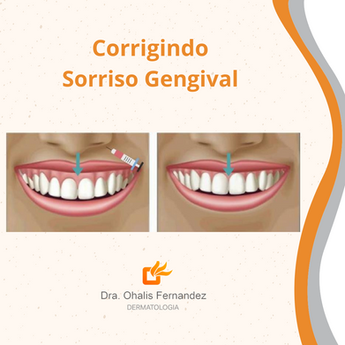 Corrigindo Sorriso Gengival