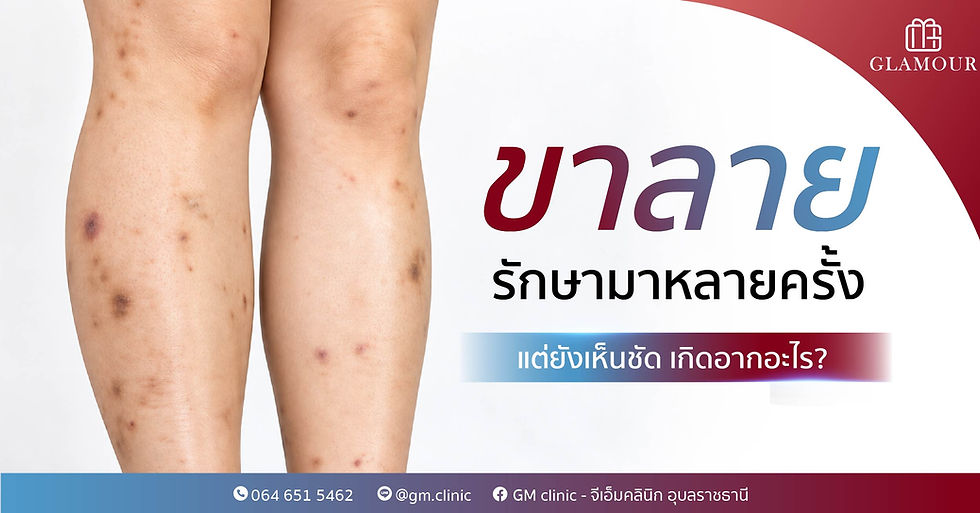ขาลายรักษามาหลายครั้ง แต่ยังเห็นชัด เกิดจากอะไร?