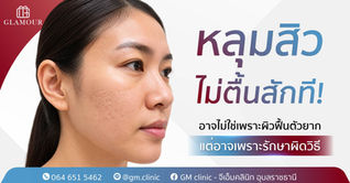 หลุมสิวไม่ตื้นสักที อาจไม่ใช่เพราะผิวฟื้นตัวยาก แต่อาจเพราะรักษาผิดวิธี