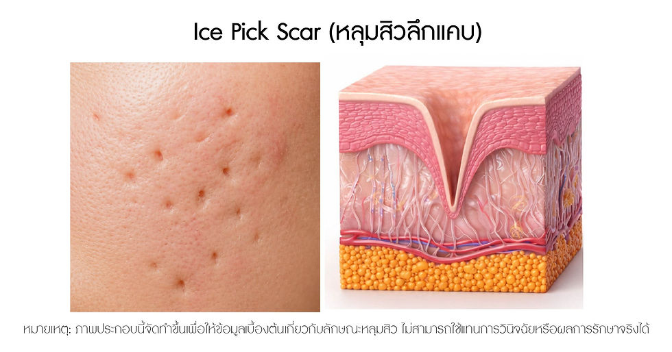 Ice Pick Scar (หลุมสิวลึกแคบ)