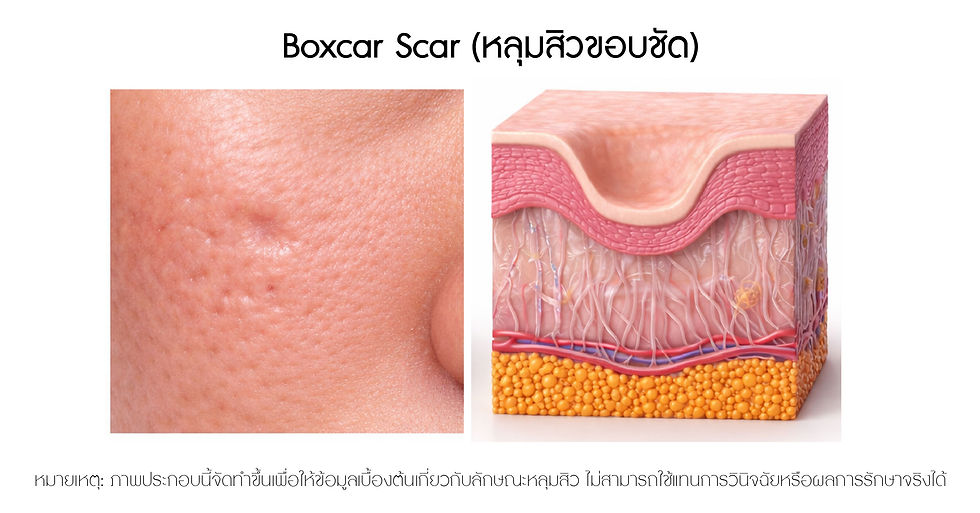 Boxcar Scar (หลุมสิวขอบชัด)