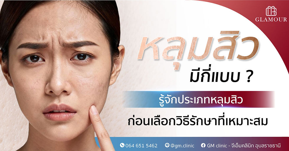 หลุมสิวมีกี่แบบ? รู้จักประเภทหลุมสิว ก่อนเลือกวิธีรักษาที่เหมาะที่สุด