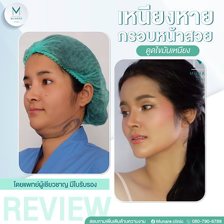 รีวิวดูดเหนียง-3.jpg