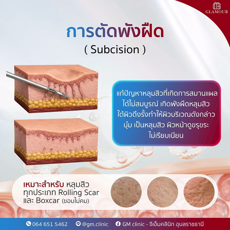 Subcision (ตัดพังผืดหลุมสิว) เหมาะสำหรับหลุมสิวที่เกิดจากพังผืดดึงรั้งใต้ผิว